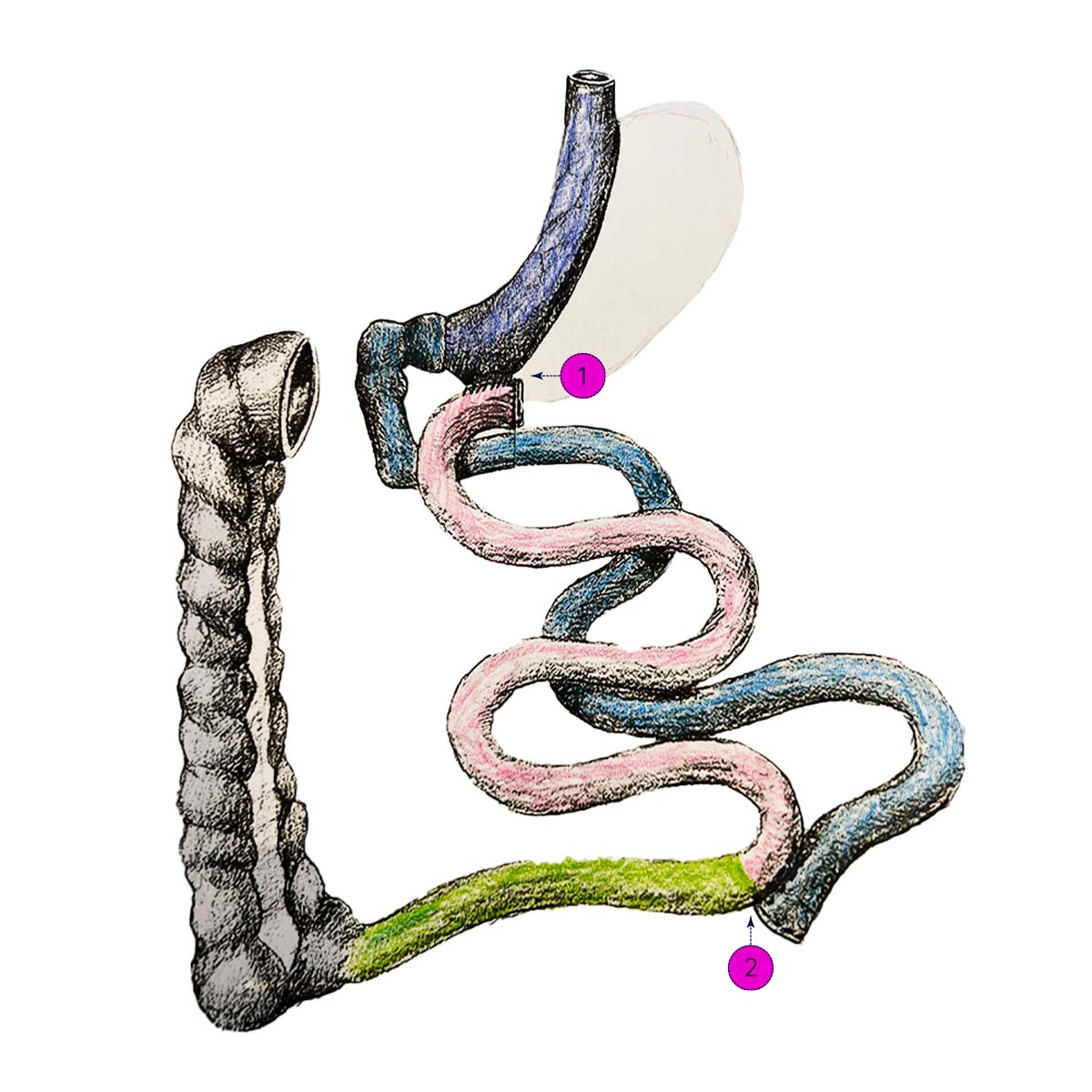 LCTB Laparoscopic Conventional Transit Bipartition