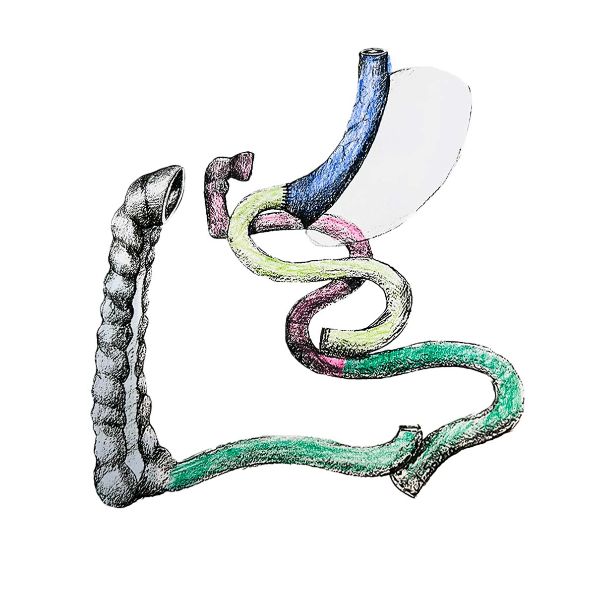 LIISG Laparoscopic Ileal Interposition with Sleeve Gastrectomy