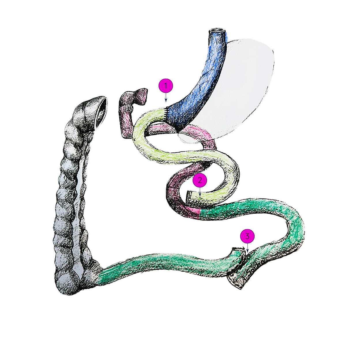 LIISG Laparoscopic Ileal Interposition with Sleeve Gastrectomy