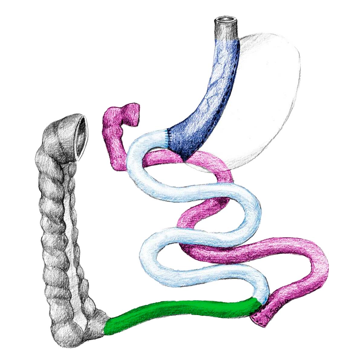 BPD-DS Laparoscopic Biliopancreatic Diversion with Duodenal Switch