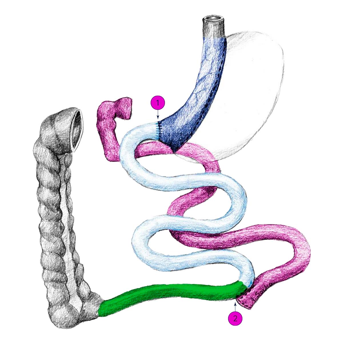 BPD-DS Laparoscopic Biliopancreatic Diversion with Duodenal Switch
