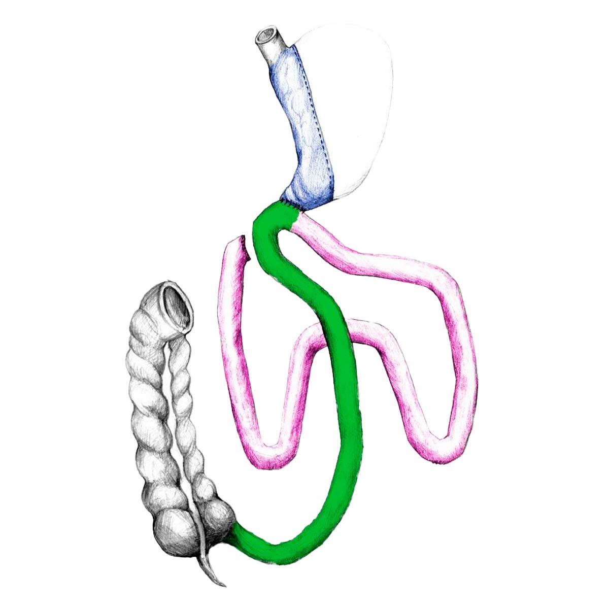 DIOS-SG Duodeno-Ileal Omega Switch with Sleeve Gastrectomy