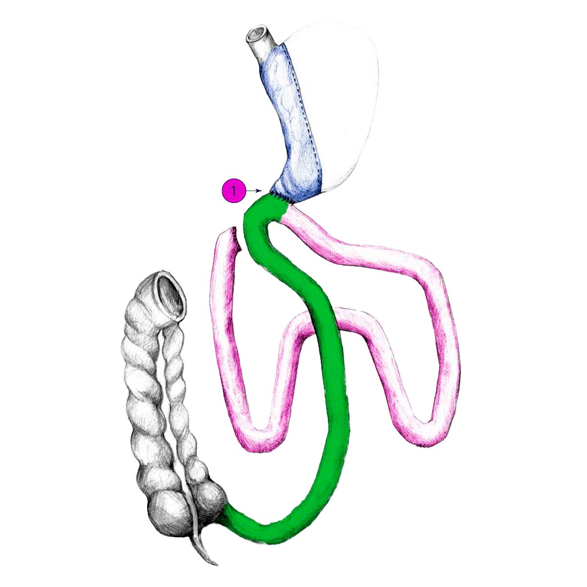 DIOS-SG Duodeno-Ileal Omega Switch with Sleeve Gastrectomy