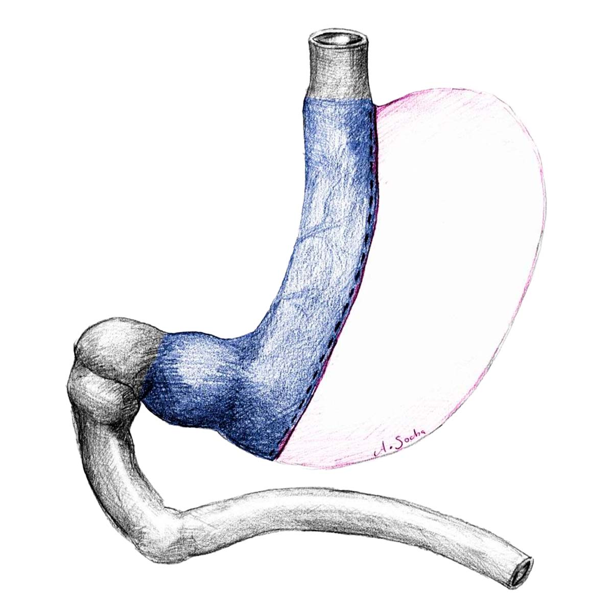 LCSG Laparoscopic Conventional Sleeve Gastrectomy