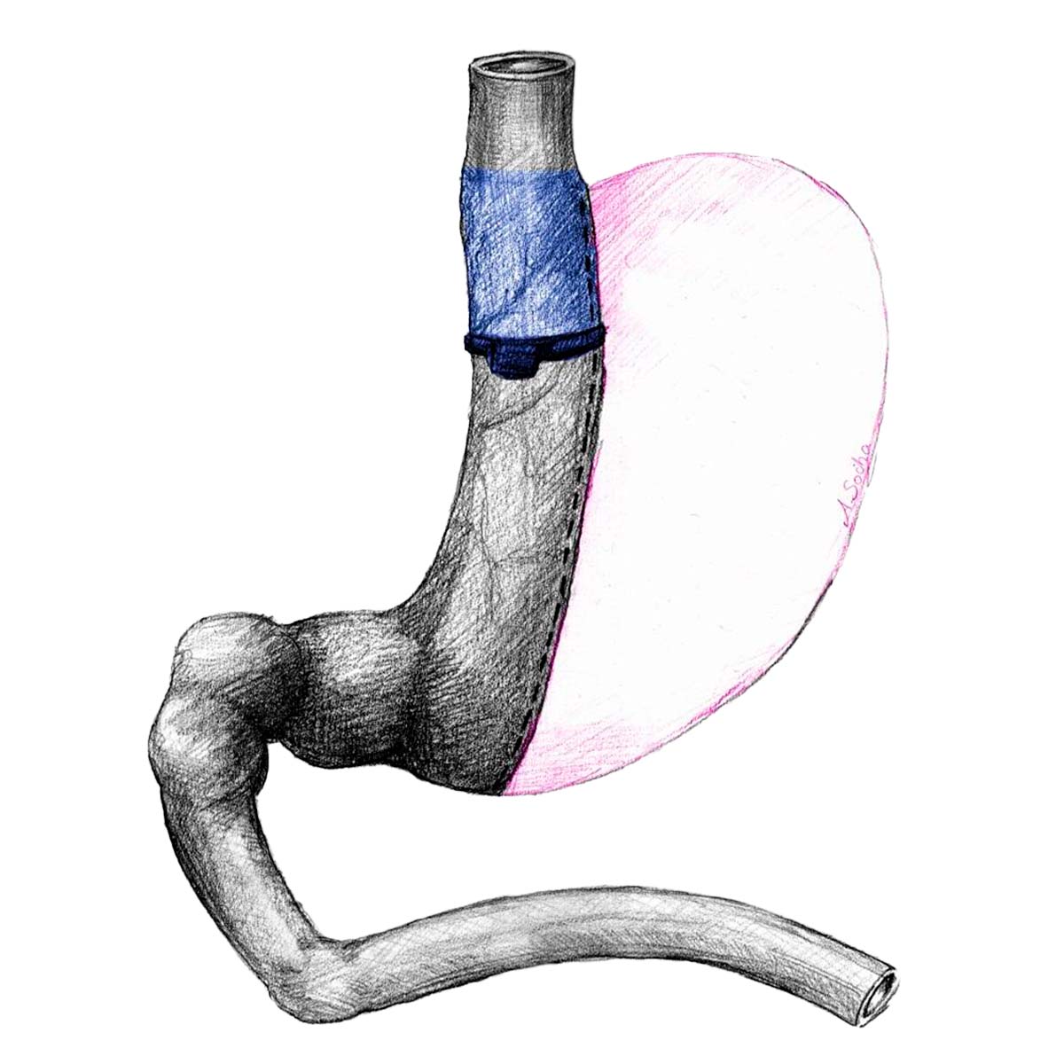LBSG Laparoscopic Banded Sleeve Gastrectomy