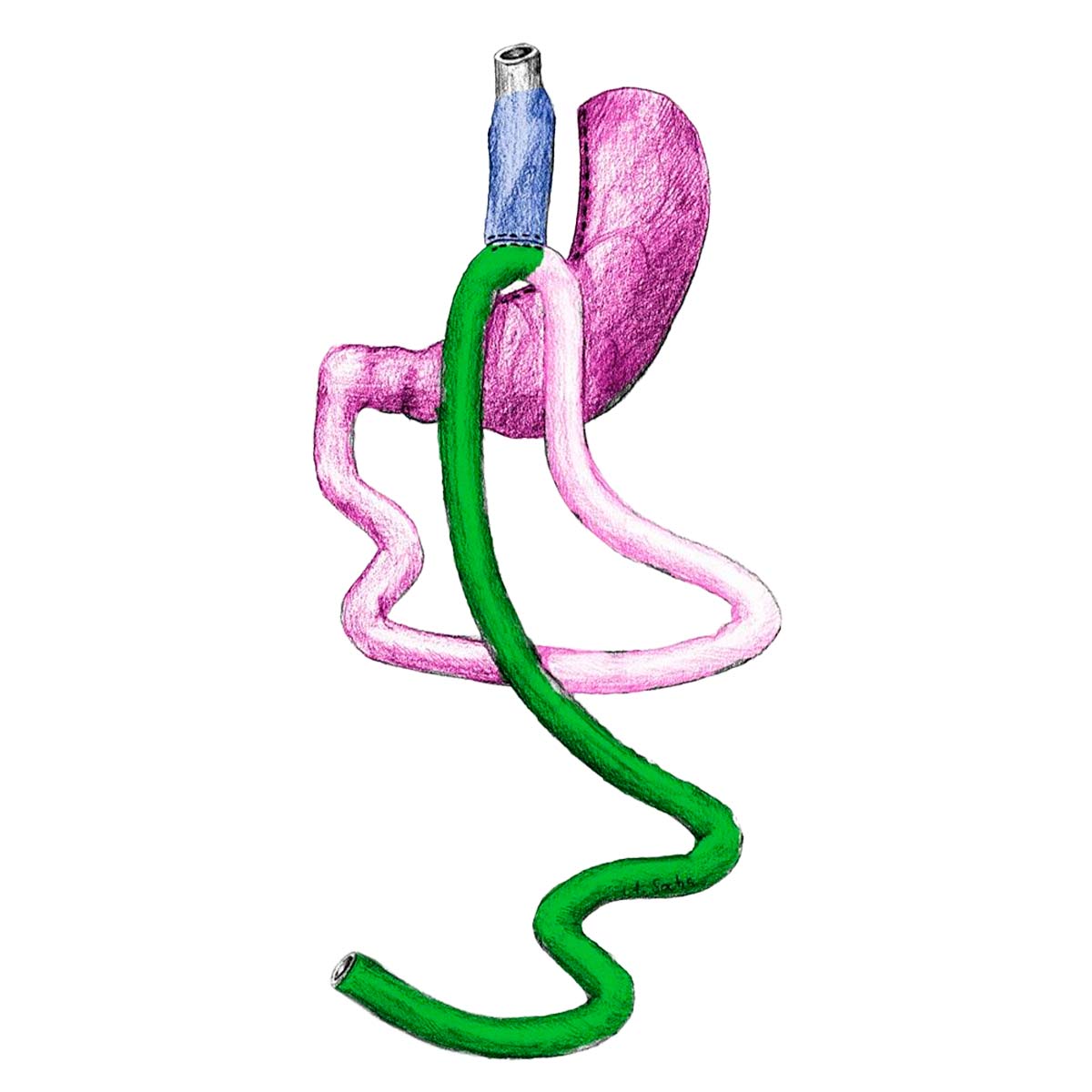 MGB Mini Gastric Bypass