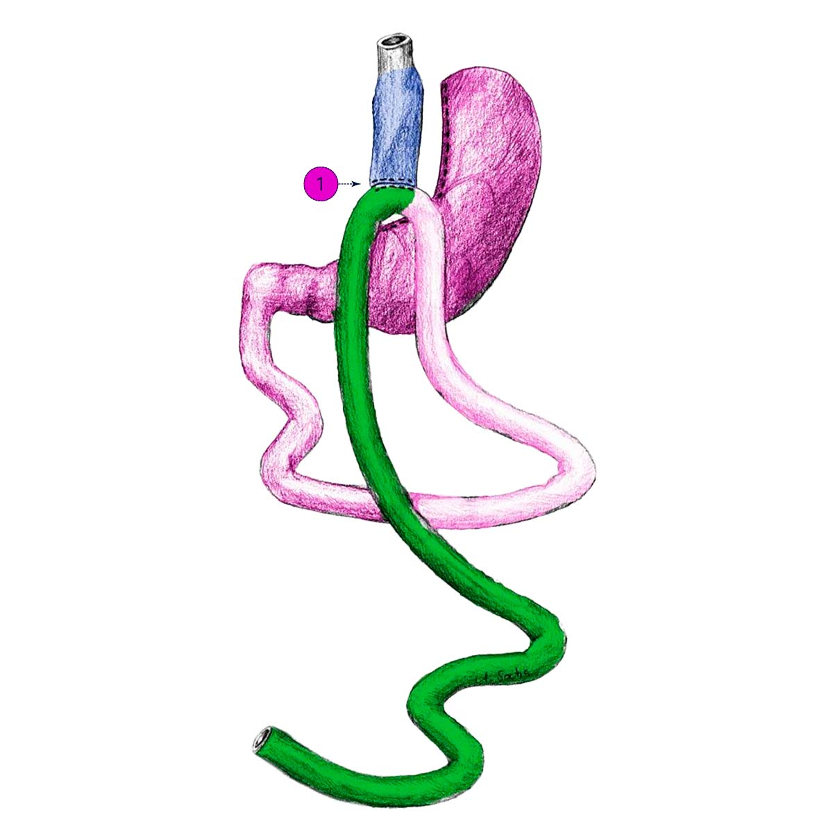 MGB Mini Gastric Bypass