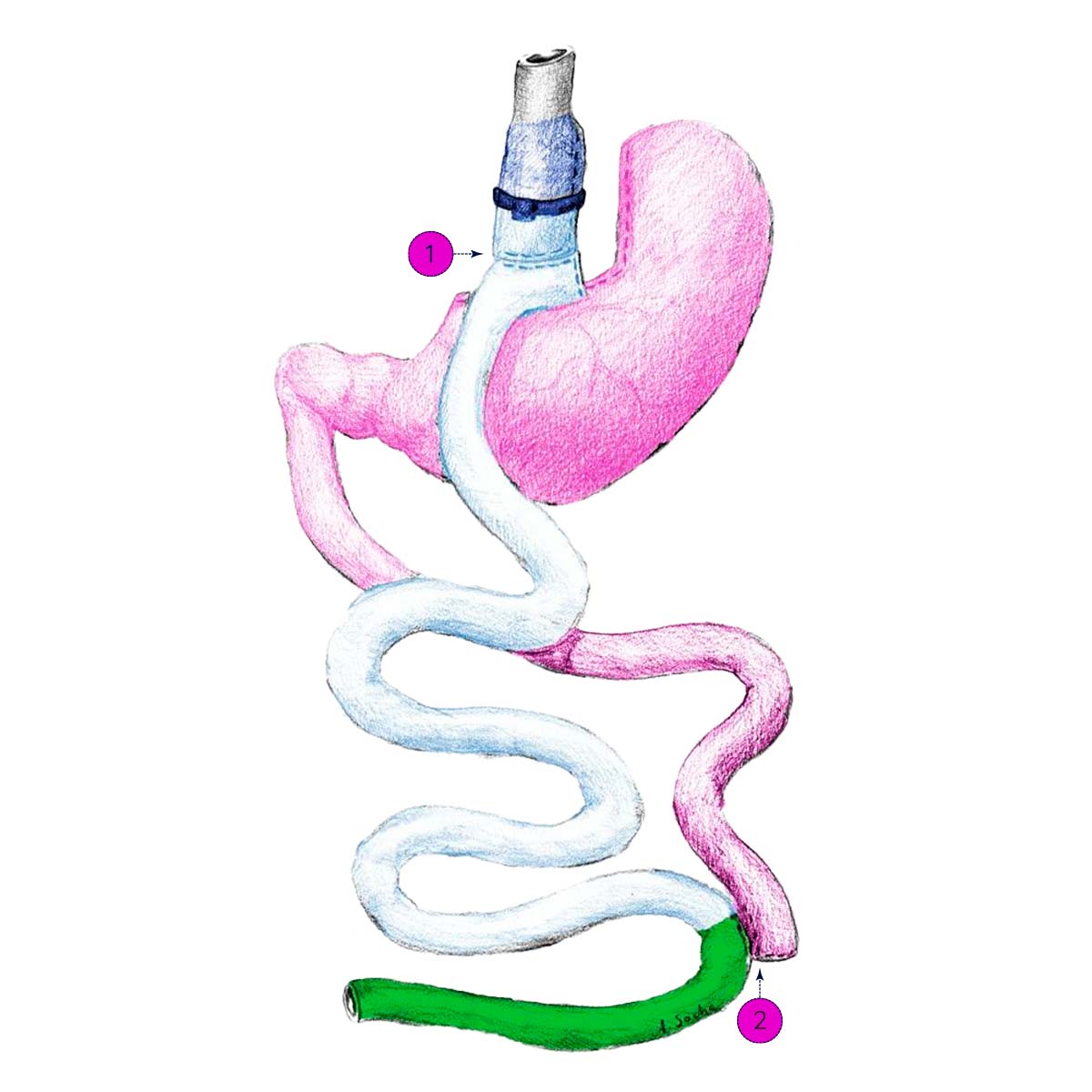 BRYGB Laparoscopic Banded Roux-en-Y Gastric Bypass